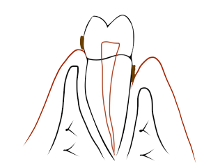 Dent devitalisee douloureuse