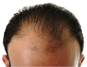 micro greffes cheveux